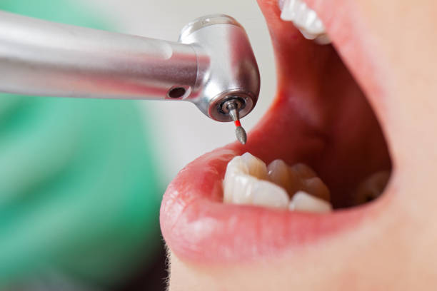 Best Emergency Dental Care for Broken or Chipped Teeth in Euless, TX